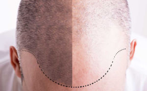 زراعة الشعر في المانيا وأهم الاطباء والمراكز المتخصصة وتكلفة الزرع