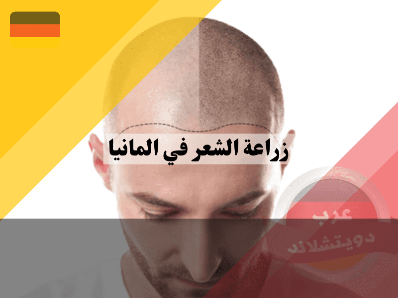 مراحل عملية زراعة الشعر في المانيا