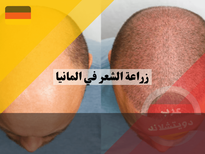 نظرة عامة حول زراعة الشعر في المانيا